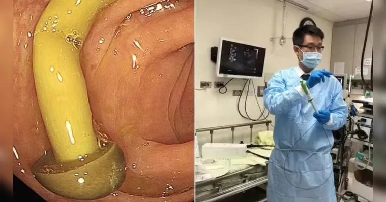 Cogumelo alojado no intestino do paciente | Divulgação