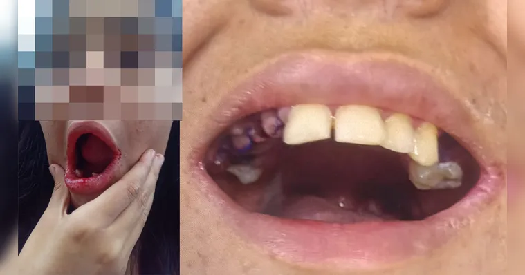 A jovem foi internada para um procedimento de restauração dentária, mas teve 17 dentes extraídos sem autorização da família. | Acervo pessoal