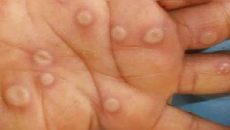 Monkeypox, popularmente conhecida como “varíola dos macacos” | Crédito: Centros de Controle e Prevenção de Doenças dos EUA