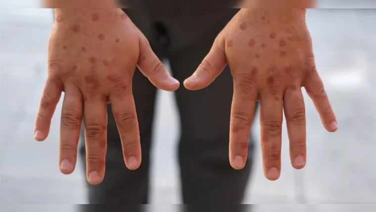 Doença é causada por vírus e é altamente infecciosa | Reprodução