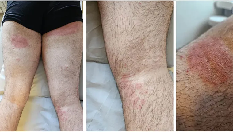 Aspectos das lesões causadas por Trichophyton indotineae | Reprodução/Revista Anais Brasileiros de Dermatologia